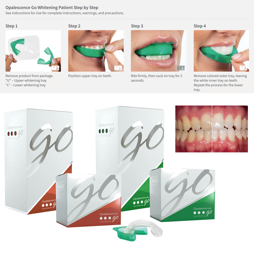 Teeth Whitening Kit At Home - Opalescence Go Teeth Whitening Trays Prefilled