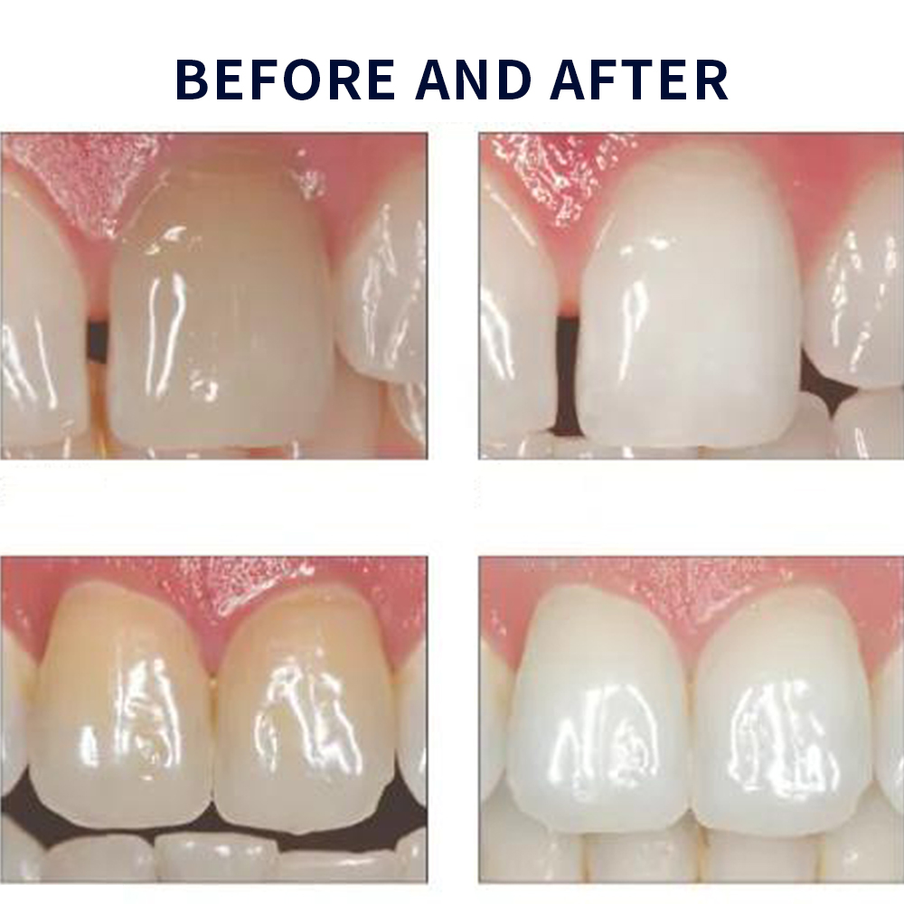 Opalescence Whitening 20% PF 2 - Teeth Whitening Kit At Home 评论和价格