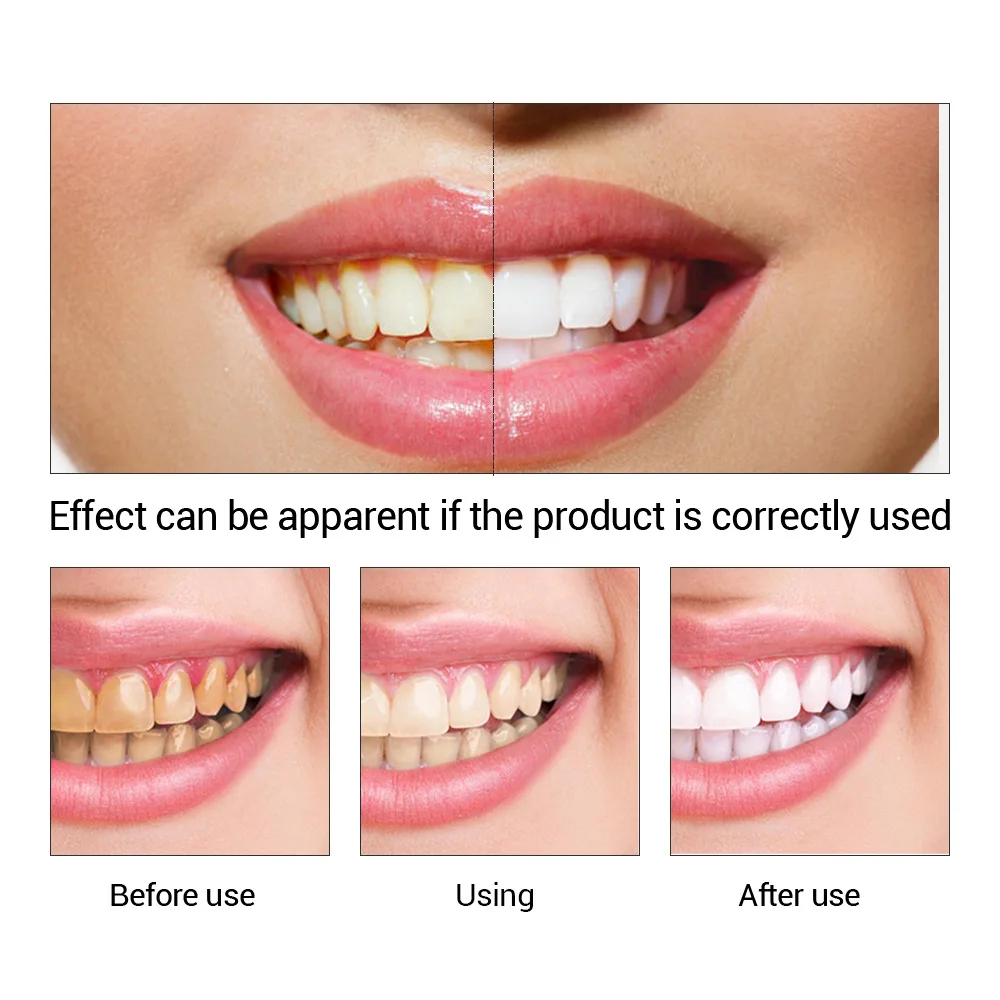 FTEENPLY Teeth Whitening Essen - Teeth Whitening Flash 评论和价格