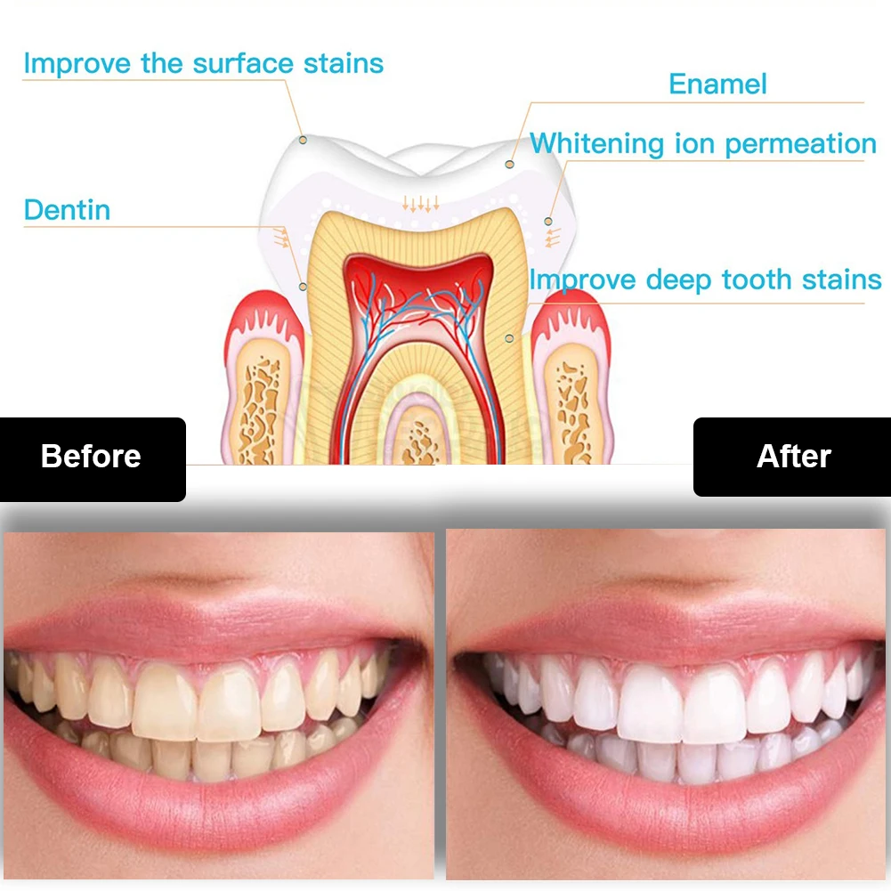 Dental Teeth Whitening Kit Min - Teeth Whitening Flash 评论和价格